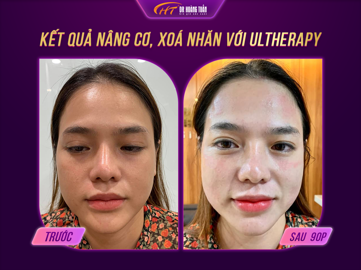 Công nghệ trẻ hóa da Ultherapy